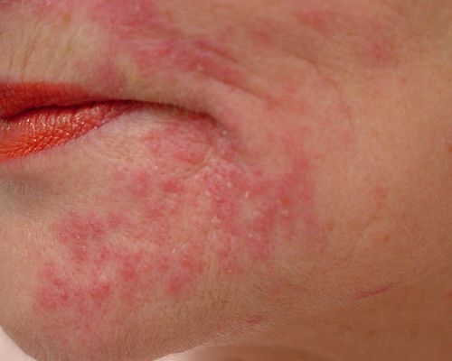 Jak vypadá dermatitis?