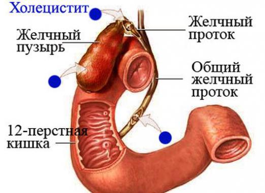 Co je cholecystitida?